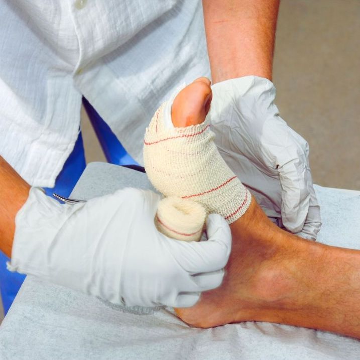 Surgery and Recovery—What to Know Before and After Bunion Removal