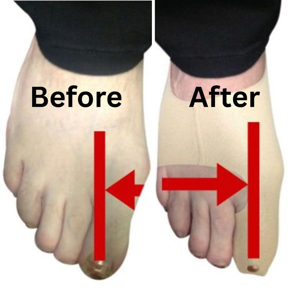 Bunions and Bunionettes—Prevention, Home Care, and When Surgery Is Needed