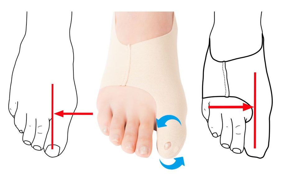 Discover the Best Bunion Treatment Options