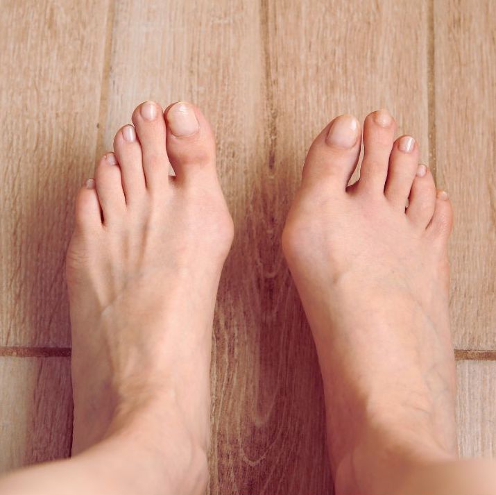 How Bunion Correctors Work? Your Options Explained