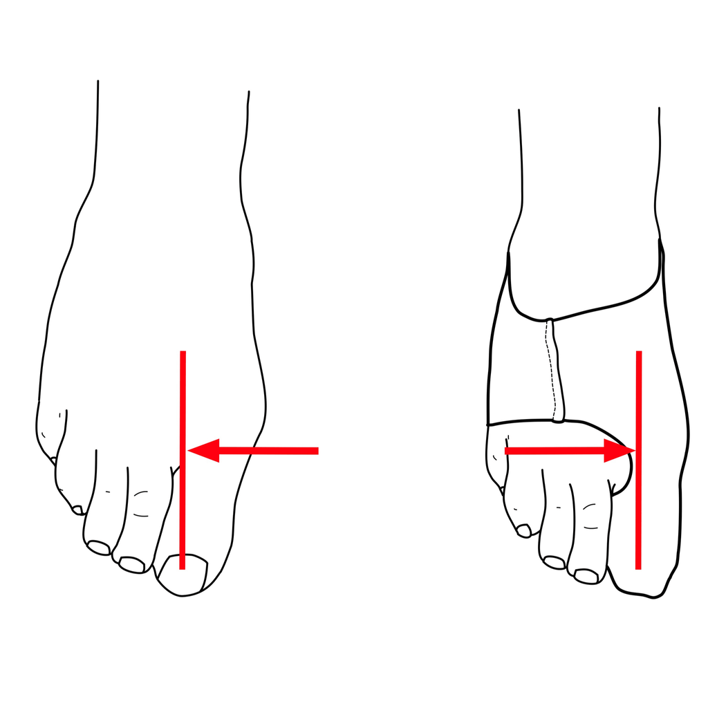 The benefits of before and after use of Bunion Sleeve