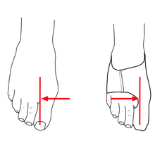 Load image into Gallery viewer, image-showing-the-benefits-of-bunion-sleeve-big-toe-correction
